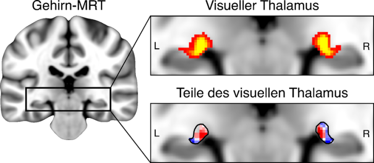 Die linke Abbildung zeigt eine Übersichts-MRT-Aufnahme des menschlichen Gehirns. Das obere Feld (rechte Seite) zeigt die Lage des visuellen Thalamus. Eine gelbe Schattierung zeigt an, dass der visuelle Thalamus bei vielen Teilnehmenden an dieser Stelle liegt. Das untere Feld zeigt die beiden Teile des visuellen Thalamus: Der bewegungsempfindliche Teil, der bei Legasthenie verändert ist, ist rot dargestellt.